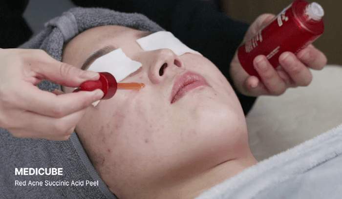 Medicube Red Acne Succinic Acid Peel — official gallery image 8