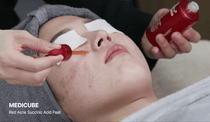 Medicube Red Acne Succinic Acid Peel — official gallery image 8