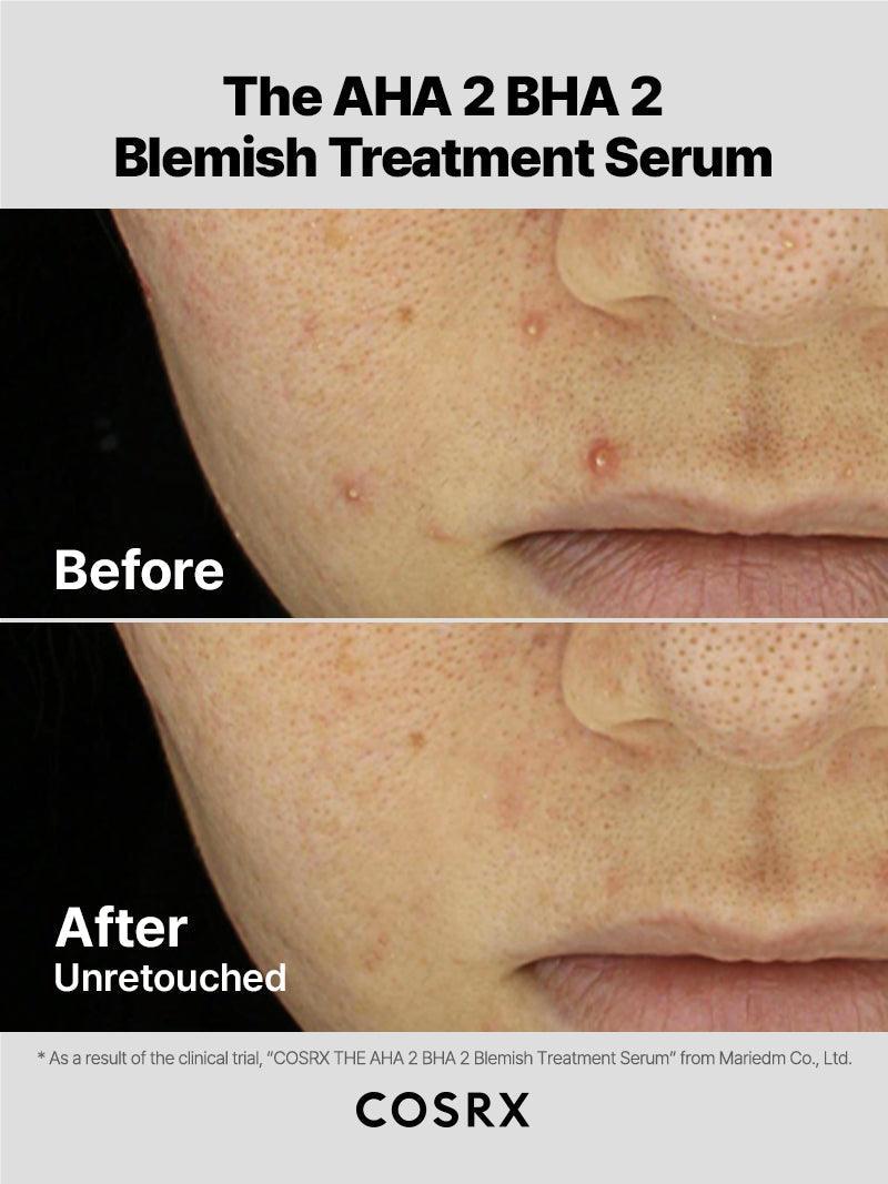 COSRX The AHA 2 BHA 2 Blemish Treatment Serum - 50g — official product gallery image 3